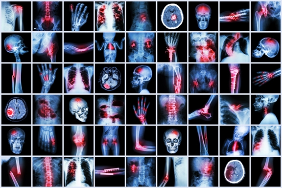 Chronic Inflammation X-ray